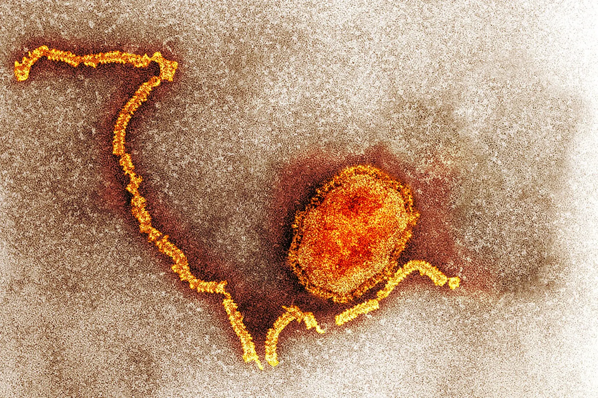 Як спалах кору 1990–1991 років пояснює повернення хвороби у 2025-му